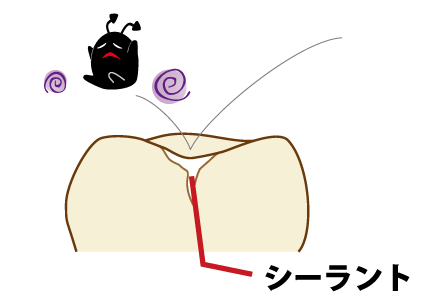 シーラントが虫歯菌をはじく