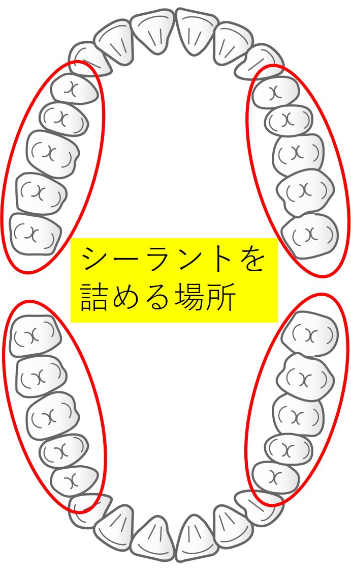 シーラントを詰められる箇所